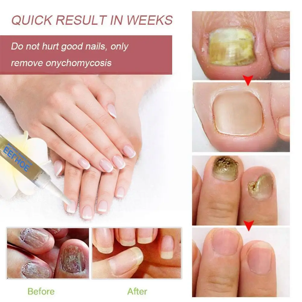 

1PC Nail Fungus Treatment Nail Oil Pen Anti Fungal Oil Agnail Nourish Skin Polish Cuticle Prevent Revitalizer Nail Tools Y3N9