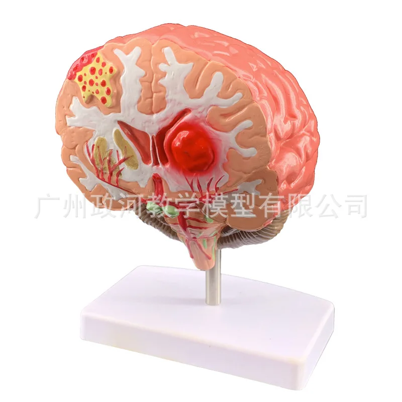 Human brain disease model Brain anatomy Neurosurgery Brain pathology Cerebral lesion model