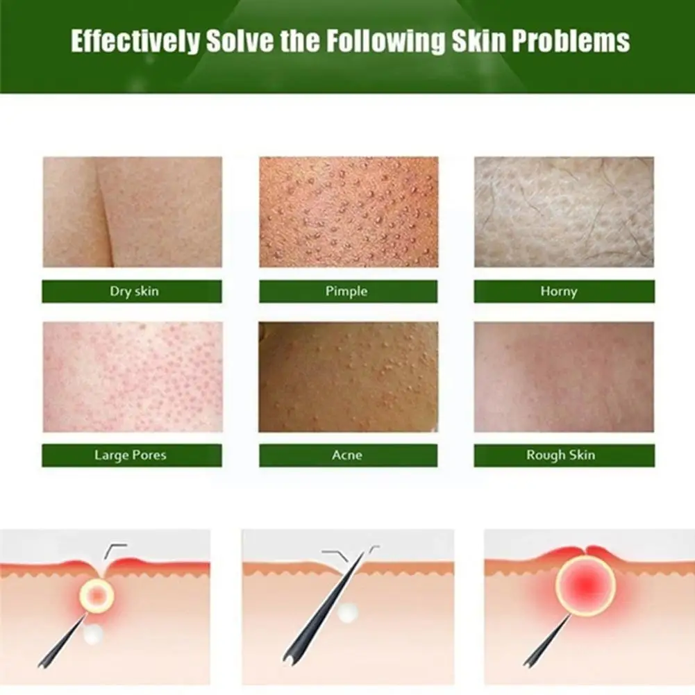 

50g Curing Keratosis Pilaris/ Kp/ Chicken Skin Body Repair And Nourishing Care Skin Skin Essence Lotion Moisturizing Cream S2S0
