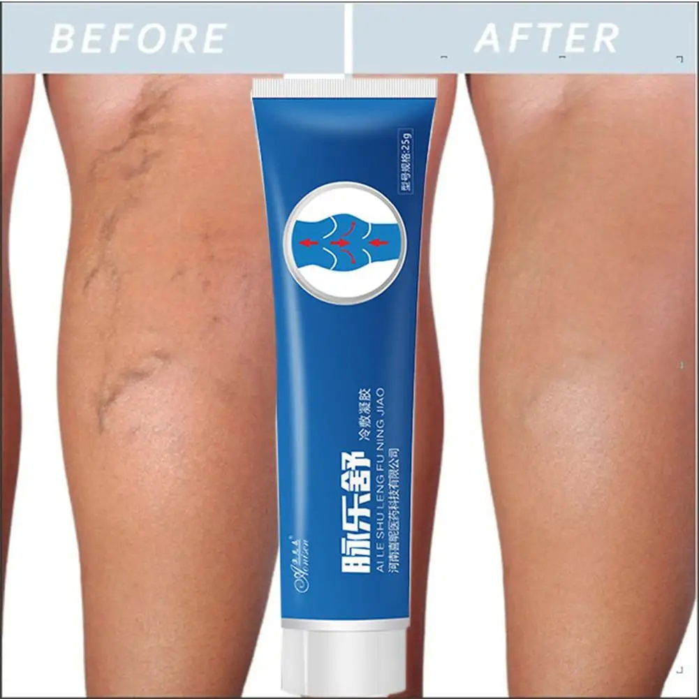 Крем от варикозного расширения вен эффективное лечение Варикозного васкулит