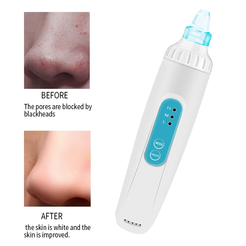 Электрический пылесос для удаления угрей акне прыщей вакуумный отсос синий