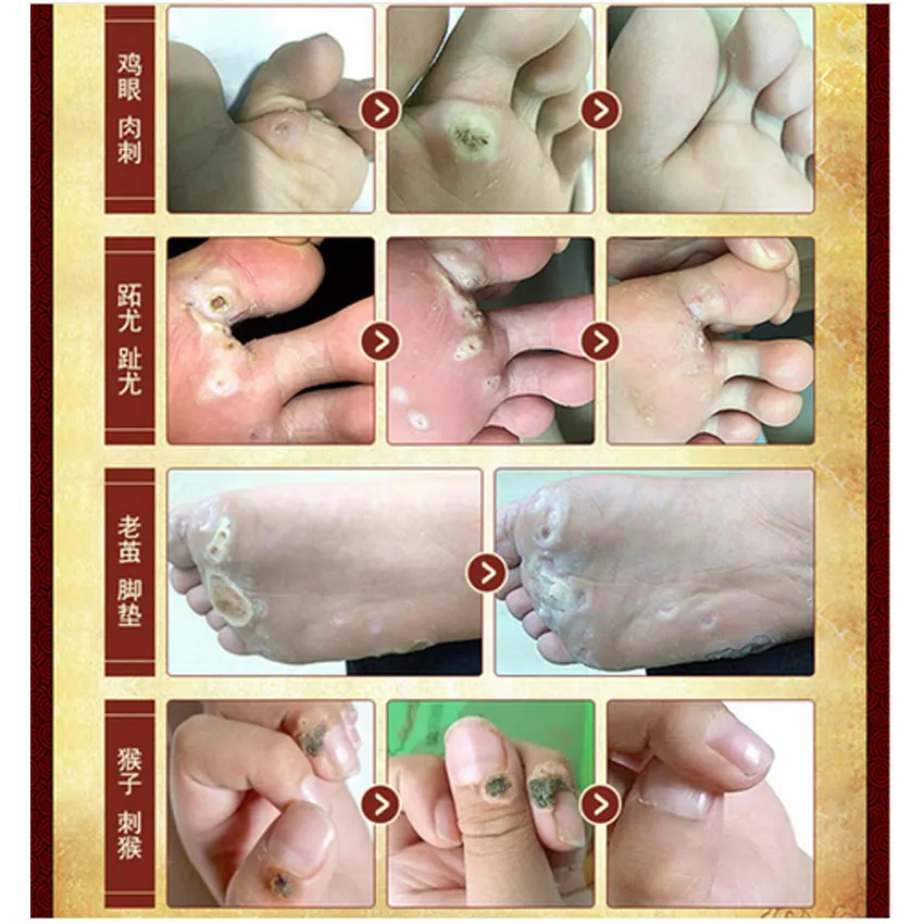 Chinese Medicine Treatment Foot Corn Removal Plantar Warts Pomada De Verruga Care Medical Plaster Ointment | Красота и здоровье