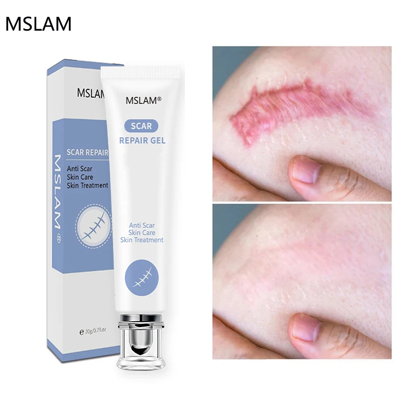 

Scar Removal Face Cream Skin Care Removal Stretch Marks Beauty Health Fades Spots Moisturizing Brighten Repair Korean Cosmetics