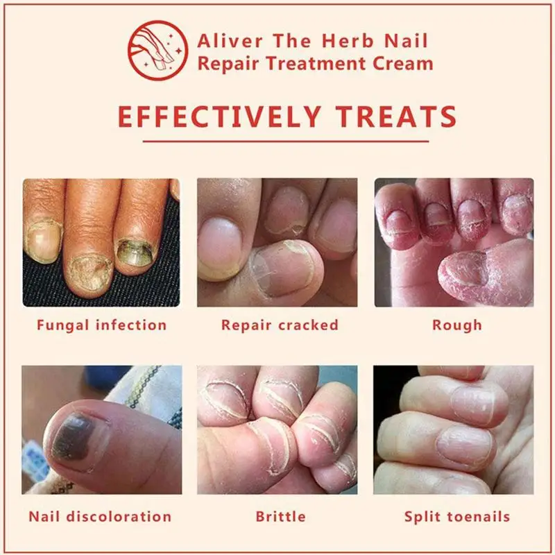

Nail Repair Cream Fungus Treatment Herb Nail Protector Cream Onychomycosis Nail Care Tools 15g