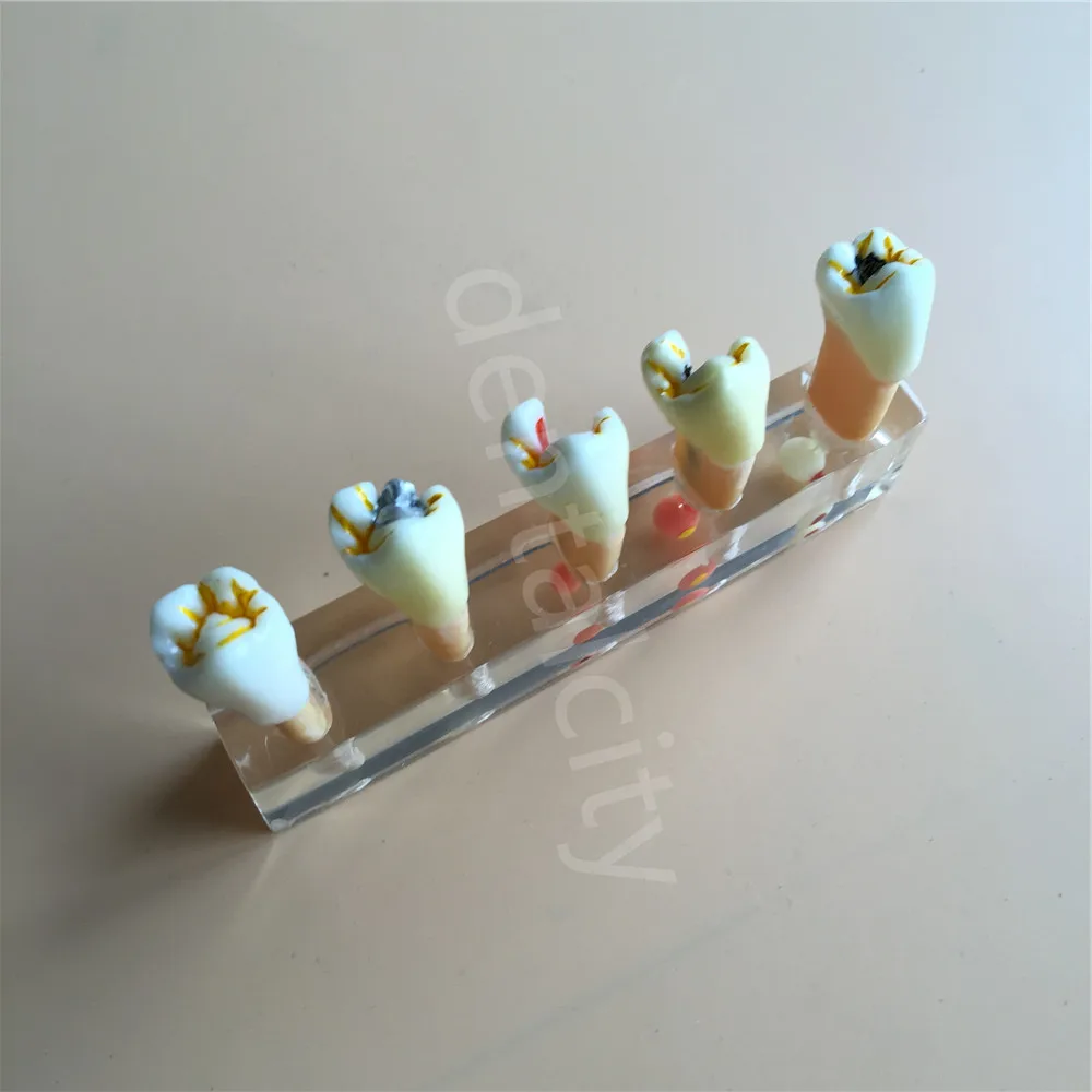 Стоматологическая 5 ступенчатая модель для лечения зубов обучения Лидер