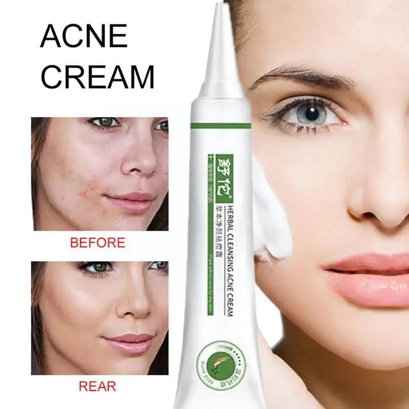 Угревой сыпи травяной крем для чистки ремонт акне косточки пор против уход