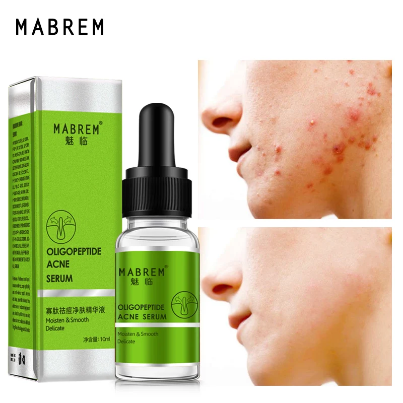 

MABREM Acne Treatment Serum Oligopeptide Acne Cleaning Pore Repair Remove Acne Lotion Whitening Brighten Essence Skin Care