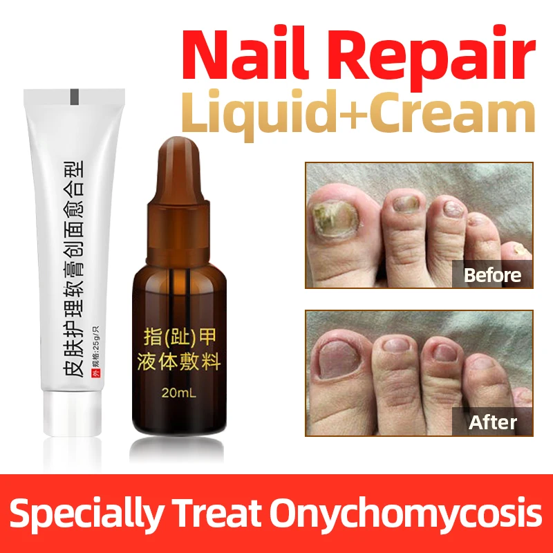

Fungal Nail Treatment Liquid Or Ointment Onychomycosis Antibacteria Repair Gel Sticker Essence Ingredient