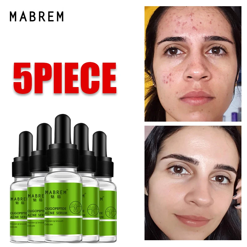 

5PCS Oligopeptide Acne Serum Acne Treatment Cream Pore Repair Shrink Pores Moisturizing Anti Anging Winkles Essence Skin Care