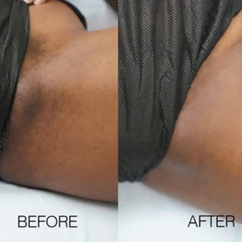 Отбеливающий крем для бедер 20 мл беззристый внутренний бедро быстрое действие |