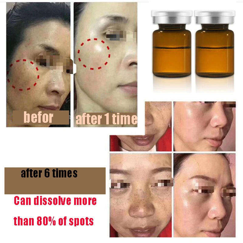 

Whitening Freckle Spot Solution Face For MTS Treatment Remove Dark Spots Melasma Pigment Melanin Acne Spot Korean Cosmetics