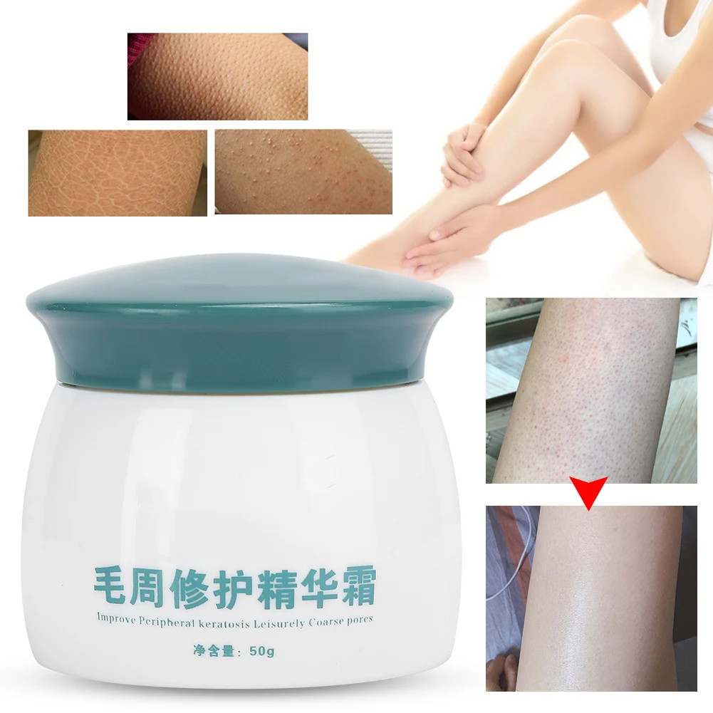 

Professional Keratosis Pilaris Cream Body Soothing Chicken Skin Treatment Soothing Coarse Pores Exfoliating Body Care Cream 50g