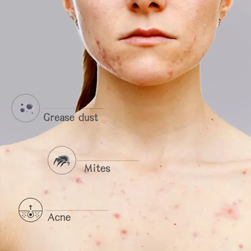 Африканское черное мыло Magic для акне сухой кожи появления удаления шрамов