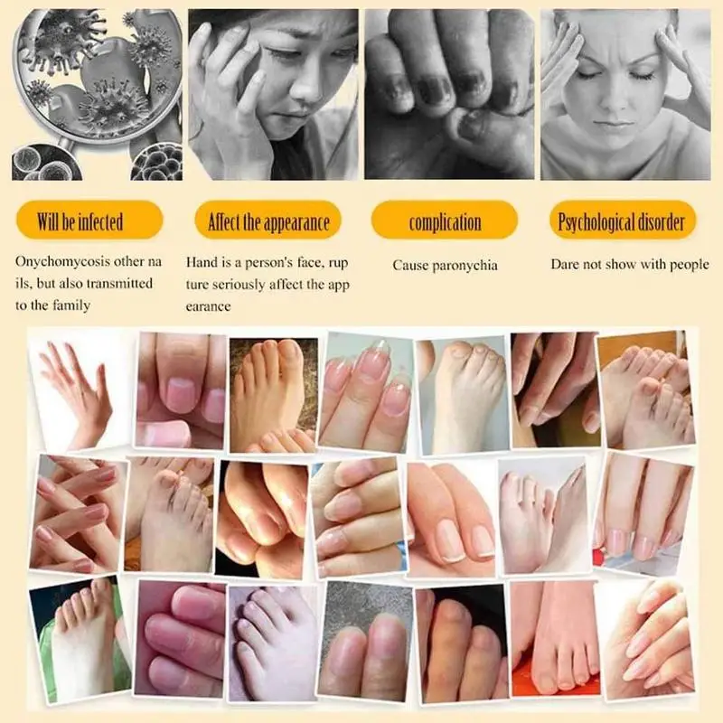 1 шт. лечение грибков ногтей отбеливание и ног удаление Уход за ногтями грибок