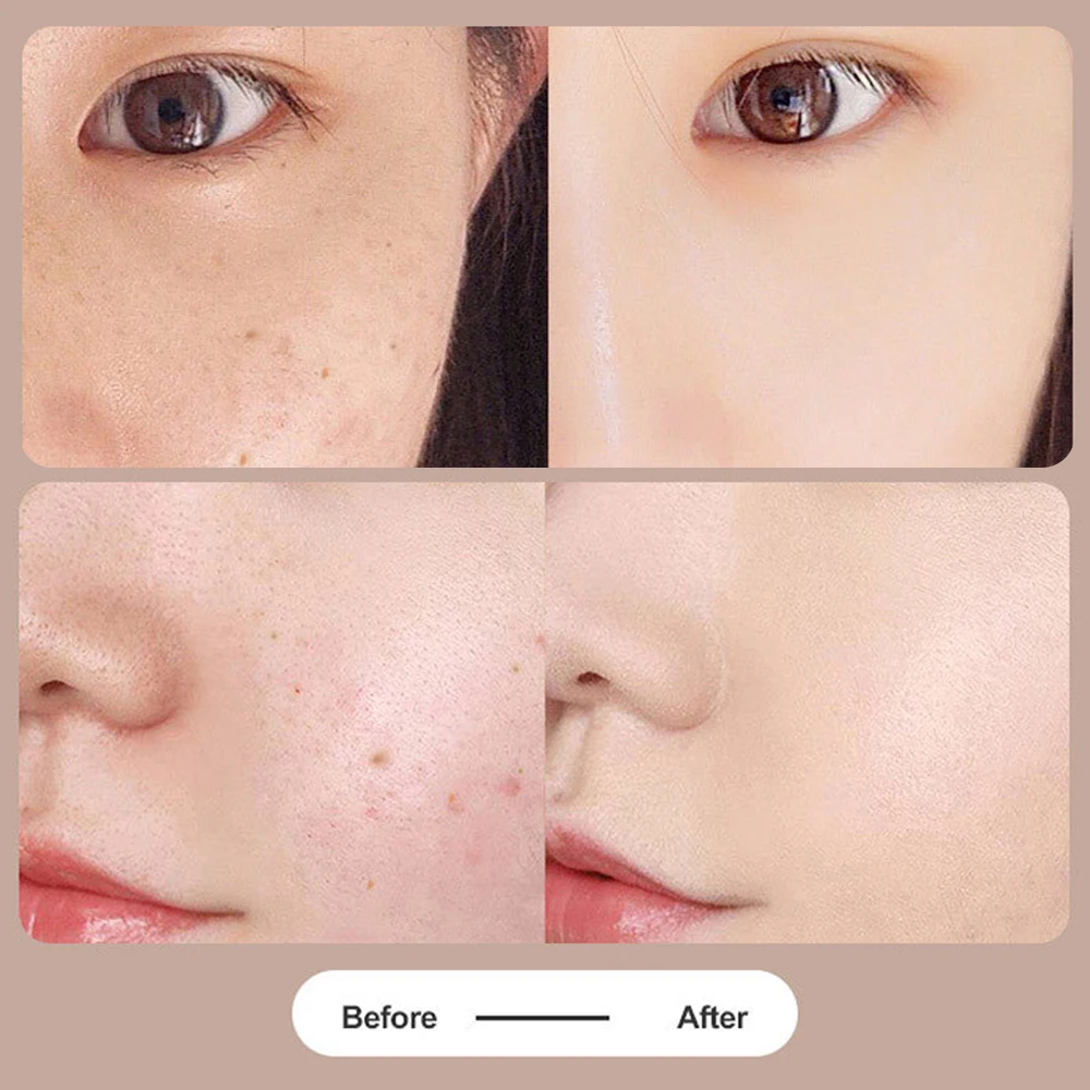 Новейшая лазерная ручка для удаления родинок плазменная с ЖК-экраном 9 уровней