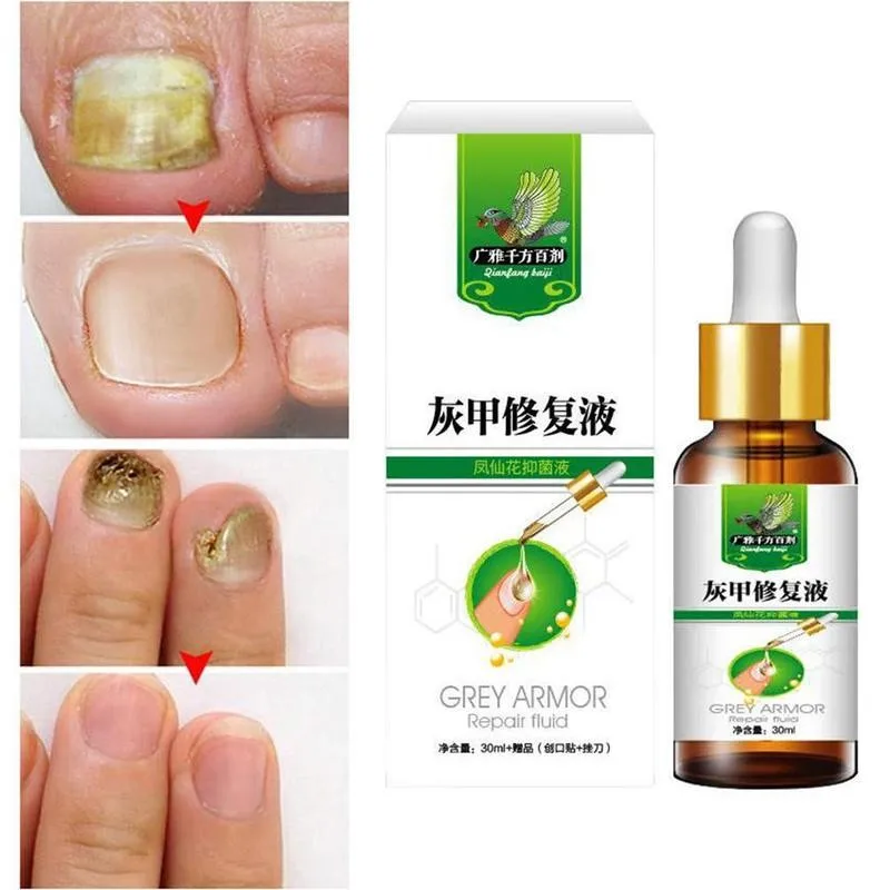 Herbal Fungal Nail Treatment Essential Oil Nail Nail Removal Anti Feet Paronychia Infection Care Fungus Onychomycosis Infec M5K7