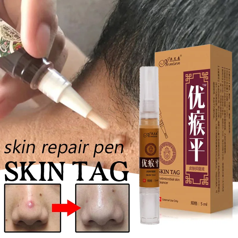 

Skin Tag Remover Against Mole & Genital Wart fast RemovWithin al Anti Foot Corn Removal Warts Papillomas Rapidly removes moles