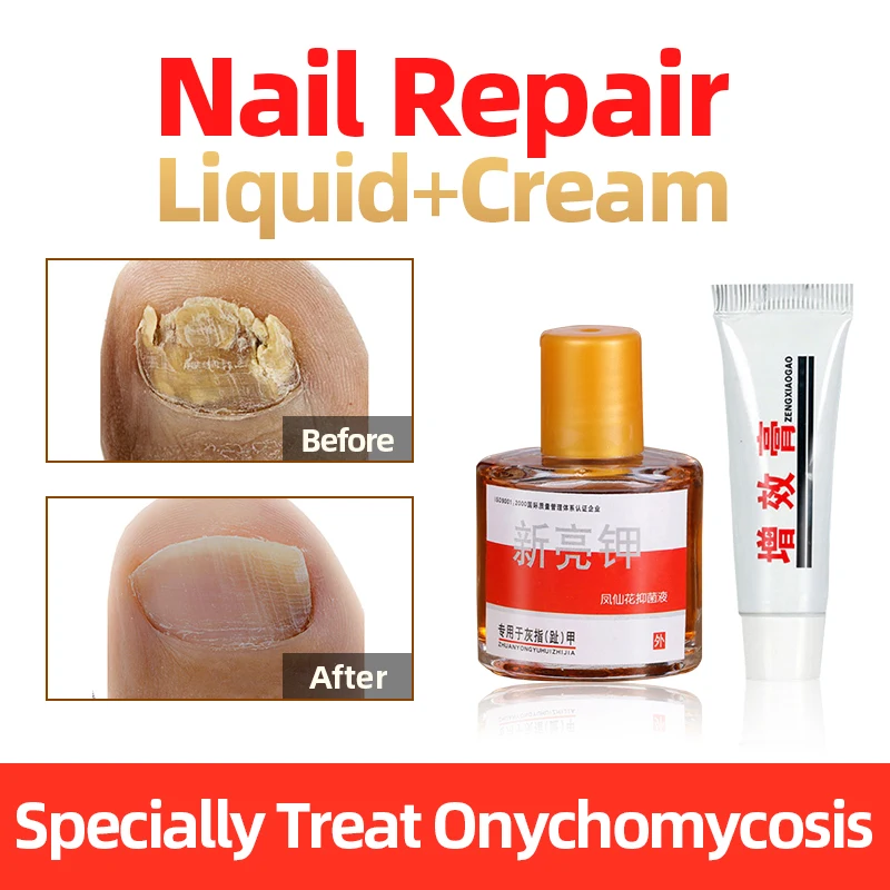 

Антибактериальная жидкость для ногтей на пальцах ног Paronychia Impatiens, лекарственный крем, противогрибковая жидкость для ногтей