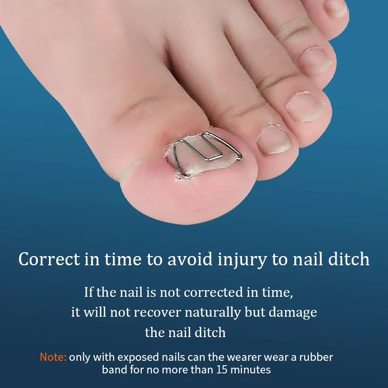 Orthodontic correction of nails and in the meat | Красота и здоровье