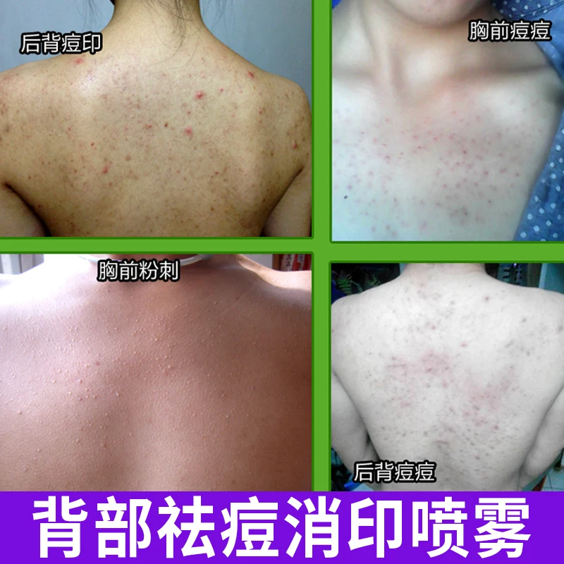 Уход за спиной эфирное масло от акне удаление шрамов и пятен уход кожей