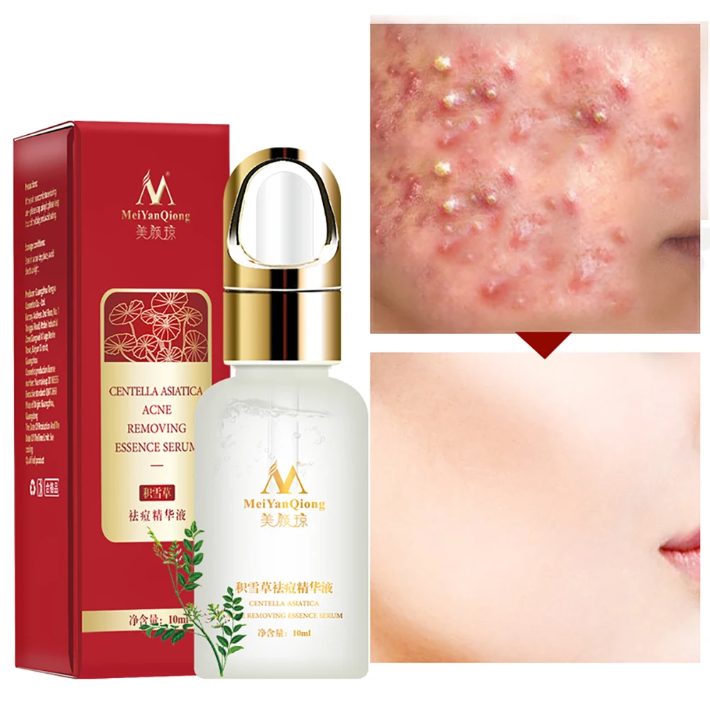 

Acne Treatment Face Serum Centella Asiatica Oil Control Shrink Pores Scar Essence Whitening Moisturizer Anti Wrinkle Skin Care