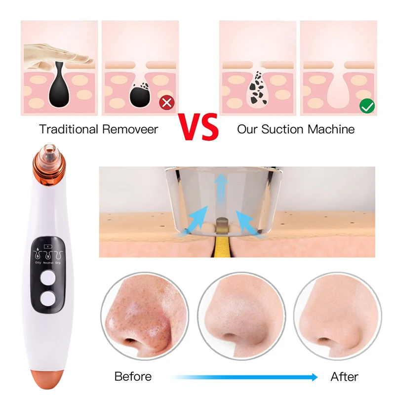 skin care beauty health Средство для удаления черных точек электронный прибор ухода за