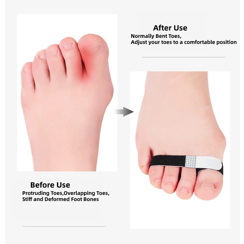 1-9Pcs Toe Stretcher Foot Finger Protector Hammer Hallux Valgus Bunion Corrector Straighteners Orthopedic Pedicure Orthosis |