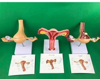 ovary and uterus disease dissection model pathology female uterus model teaching human medical aids anatomy lesion uterus