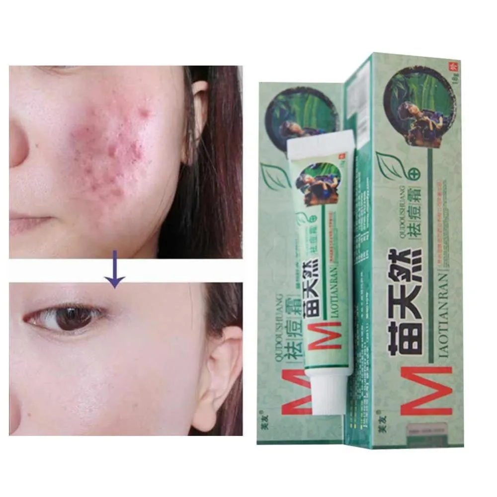 

10pcs/lot Original Fuyou Miaotianran Remove Acne Cream Germicidal Remove Mite and Moisturize Your Skin for Facial Treatment 18g