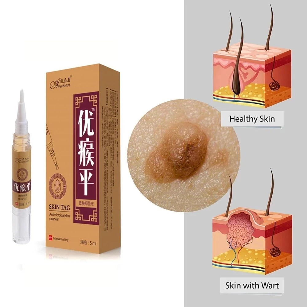 

Skin Tag Remover Against Mole & Genital Wart fast Remov Within al Anti Foot Corn Removal Warts Papillomas Rapidly removes moles