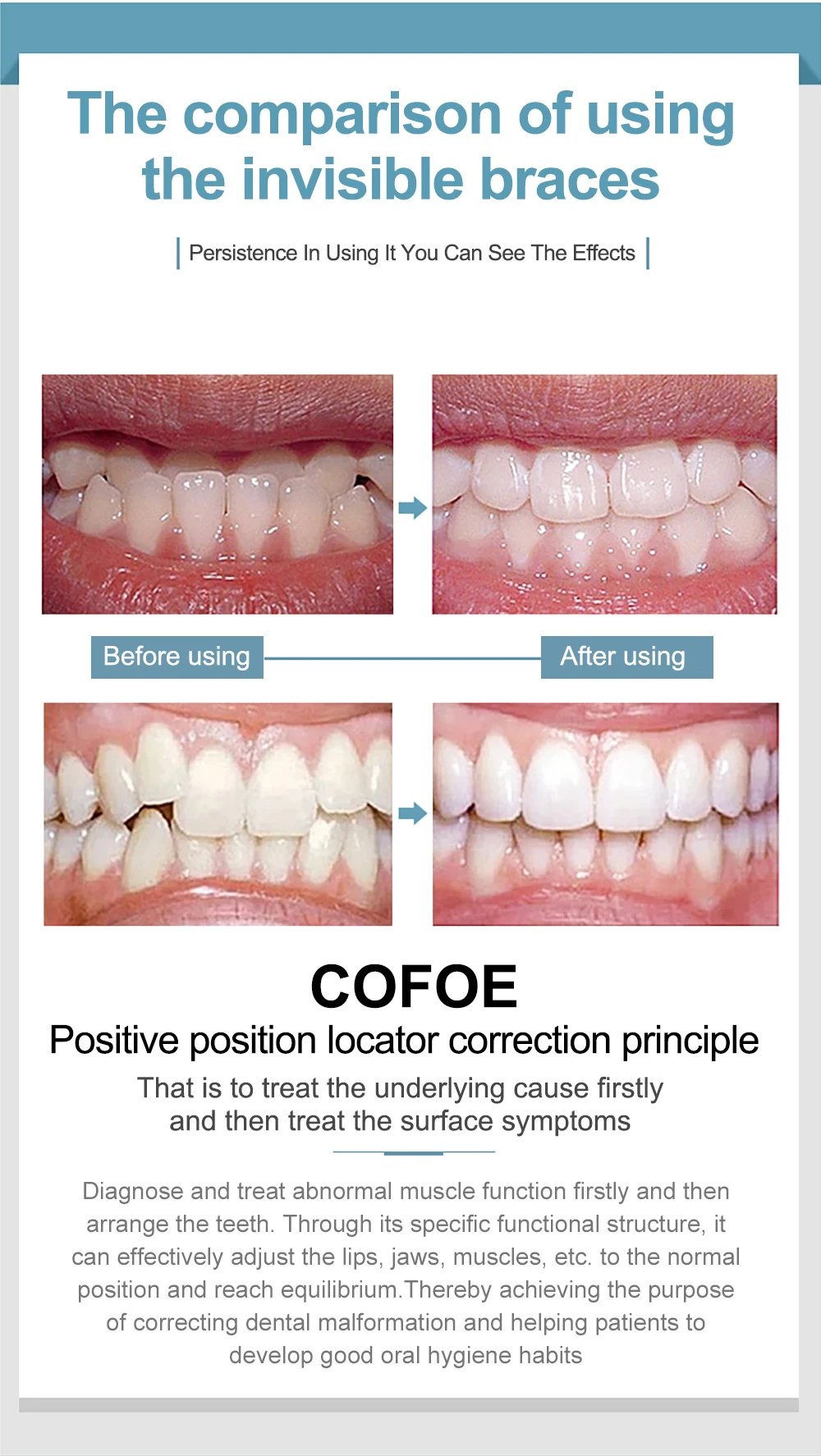 Cofoe Dental Braces Orthodontic locator Invisible orthodontic bracket For Smile Teeth Alignment Trainer and dental care With box