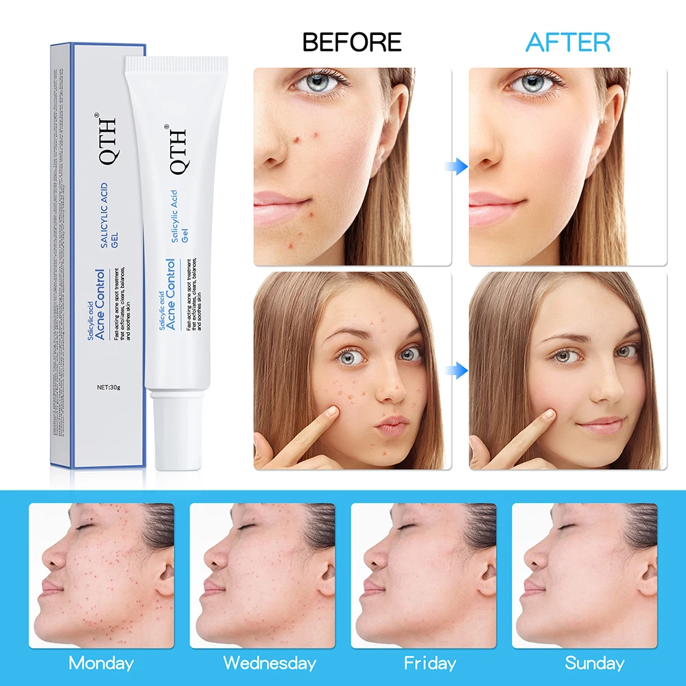 

Salicylic Acid Acne Spot Treatment Gel for Face/Chest/Back Skin Care Fast-acting Facial Cleanser and Pimple Eliminator