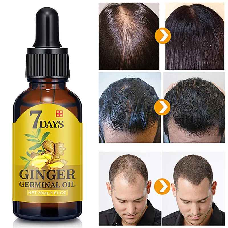 

Ginger Hair Growth Essence 7 Days Germinal Oil Hair Loss Treatment for Men Women Growth Hair Regrowth Serum Essential Oil 30ml