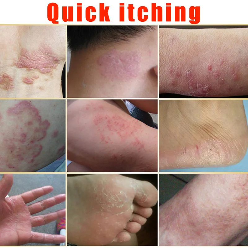 Advanced Body Psoriasis Cream For Dermatitis and Eczema Pruritus Ointment Herbal Creams |