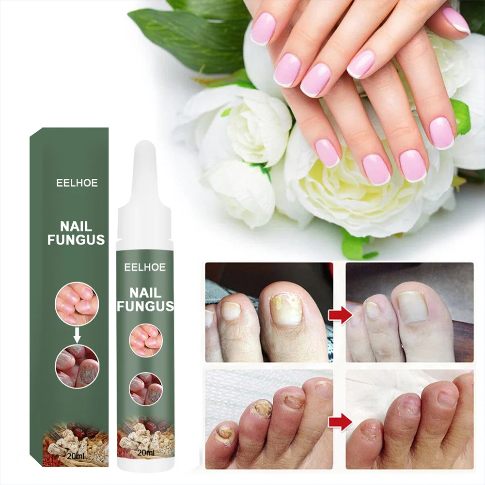 

Nail fungus treatment antifungal solution to promote new growth of nails nail toenail onychomycosis repair solution