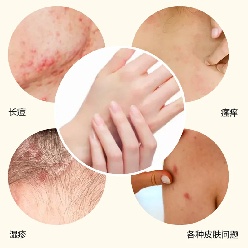 

Baby care cream for skin itching, baby comfrey antibacterial cream to prevent mosquito bites and skin allergies