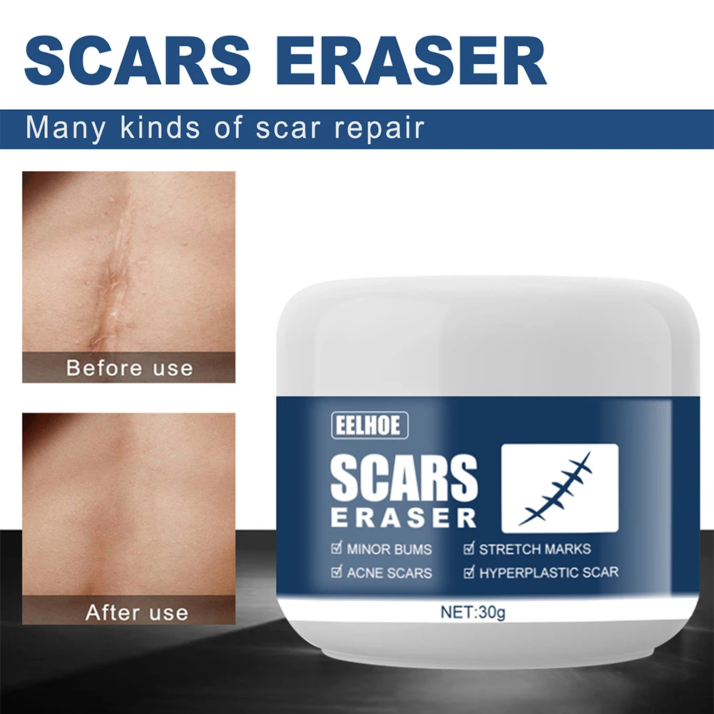 

Body Maternity 30g Pigmentation Repair Spots Stretch Marks Skin Care Scar Removal Cream Burns Scald Acne Treatment Ointment