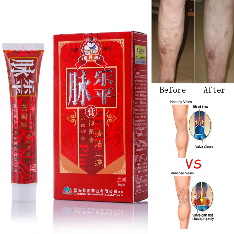

Varicose Veins Treatment Cream Effective Vasculitis Phlebitis Spider Veins Varicosity Angiitis Treatment Ointment Herbal Cream