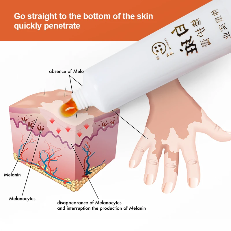 3Pcs Vitiligo Treatment Ointment White Spots Leukoplakia Disease Repair Cream Melanin Promoting Medical Plaster Health Care | Красота и