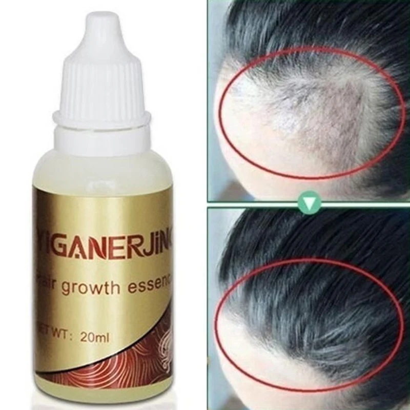 

Эссенция для лечения выпадения волос, роста волос, жидкость для волос 20 мл, восстановление волос, восстановление роста волос, повреждение во...