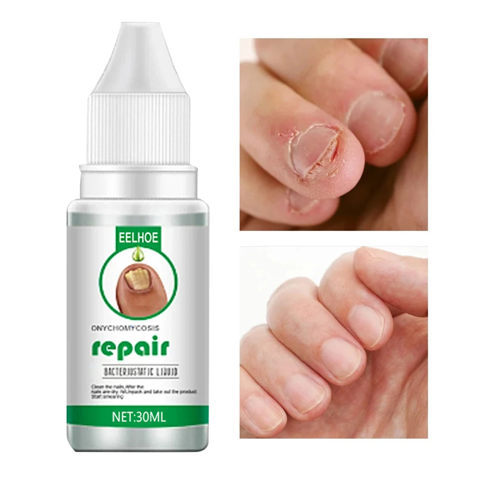 

Nail Fungus Treatment Serum Fungal Fingernails and Toenails Repair Promote New Growth Renew Cracked Fungal Nails Solution