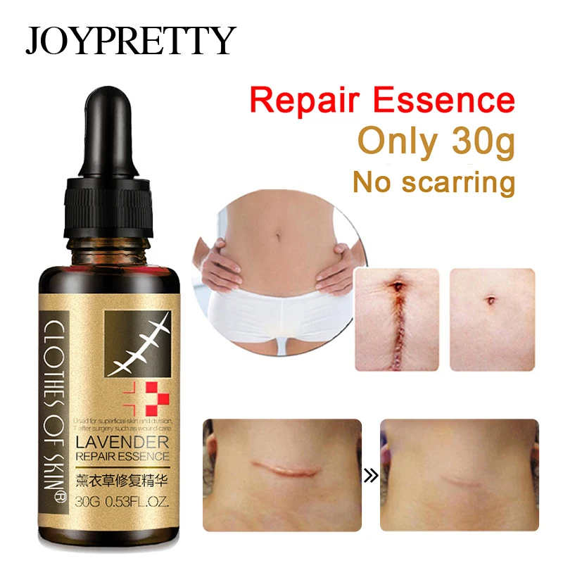 

30g Lavender Essence Scar Repair Skin Essential Oil Natural Pure Remove Ance Burn Strentch Marks Scar Removal