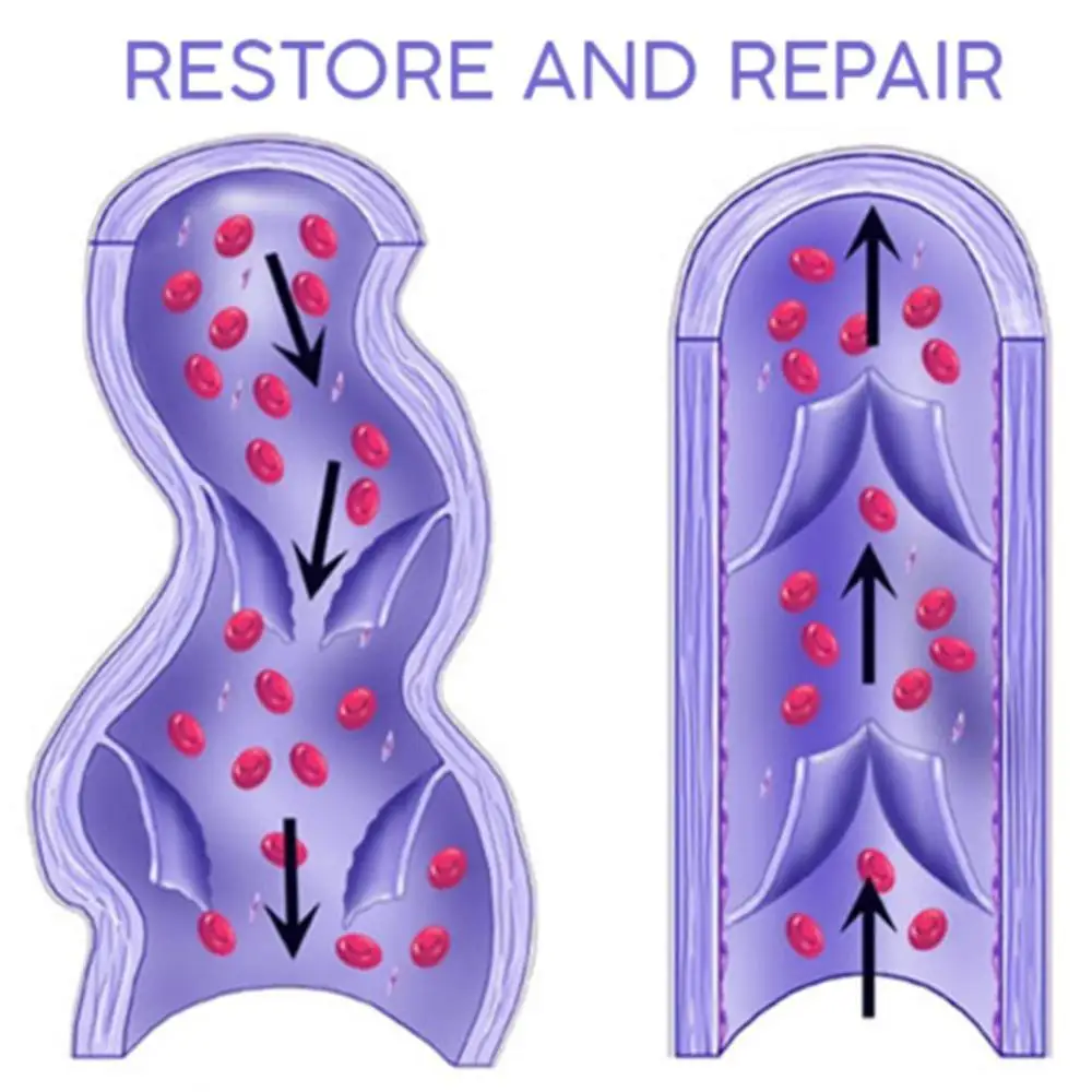 3 шт. сосудистых звездочек варикозное расширение обработка штукатурка вен