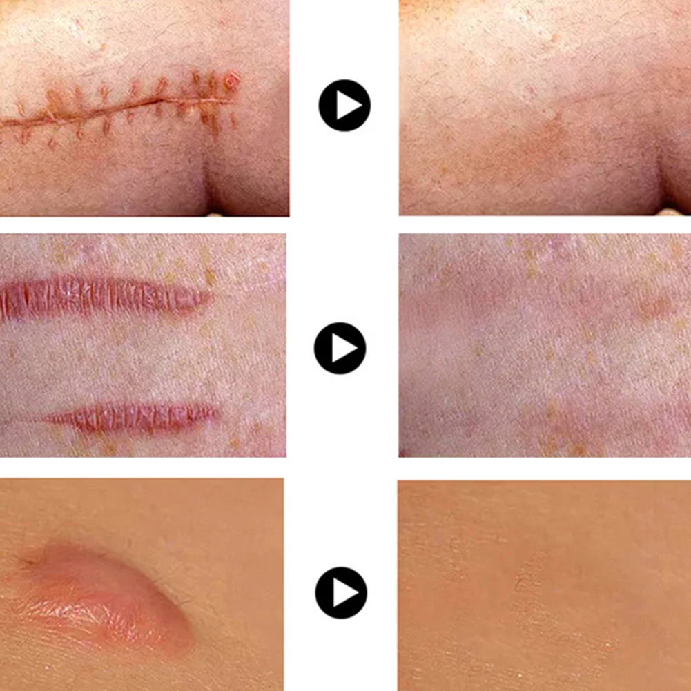 

VOVA Whitening Removal Scar Acne Cream Stretch Marks Face Pimples Gel Remove Acne Smoothing Moisturizing Body Beauty Skin Care