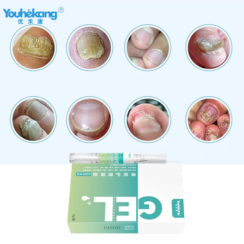 Youhekang онихомикоз лечение грибковых ногтей Уход за ногами Сыворотка для удаления