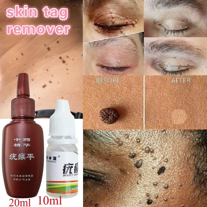 

10ml/20ml Skin Tag Remover 12 hours Medical kill Remover Skin Tag Mole & Genital Wart Remover Foot Corn Removal
