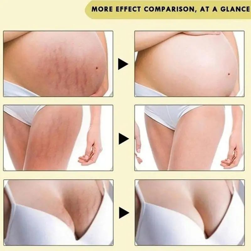 Removal Stretch Mark Cream Repair Abdomen Scar Acne Cell Regeneration Beauty Skin Promote Cosmetics L3D6 |