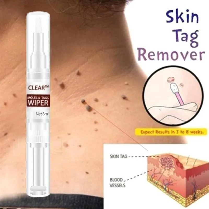 

3ml Clear Tags & Moles Remover Liquid Wart Removal Pen Genital Wart Treatment Hot Sell