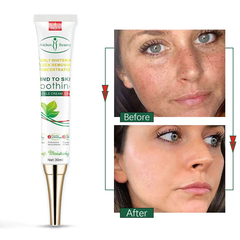 

Effective Whitening Freckle Cream Remove Dark Spots Melasma Gel Acne Spot Inhibit Melanin Brighten Moisturizing Skin Care 30g