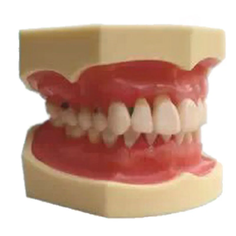 

Periodontal Disease Teeth Teeth Model for Medical Teaching